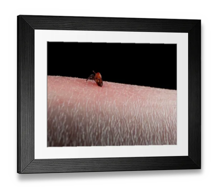 Framed Print : Tick (Acarina sp. ) adult, feeding, on human skin with inflammation, England, june
