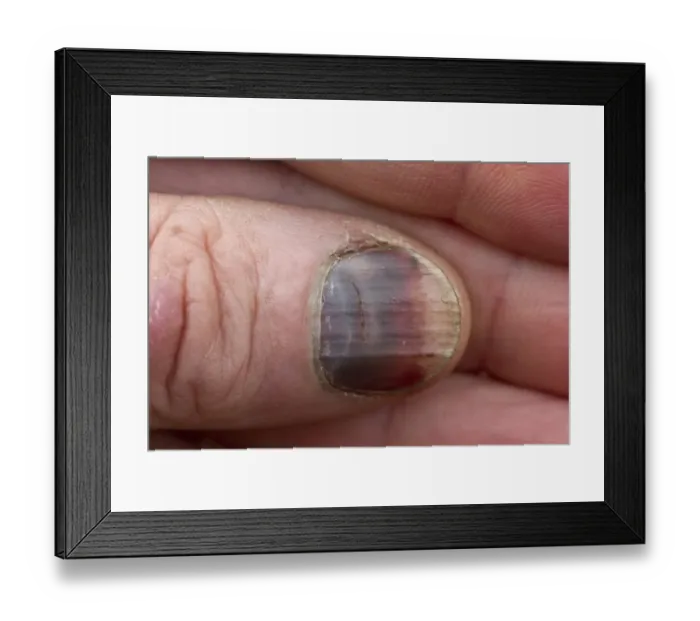 Framed Print : After an accident to a fingernail it has turned black Framed Print : After an accident to a fingernail it has turned black