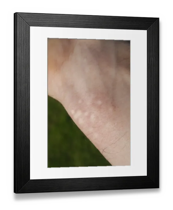 Framed Print : Stinging Nettle (Urtica dioica) stung human wrist, Suffolk, England, may Framed Print : Stinging Nettle (Urtica dioica) stung human wrist, Suffolk, England, may