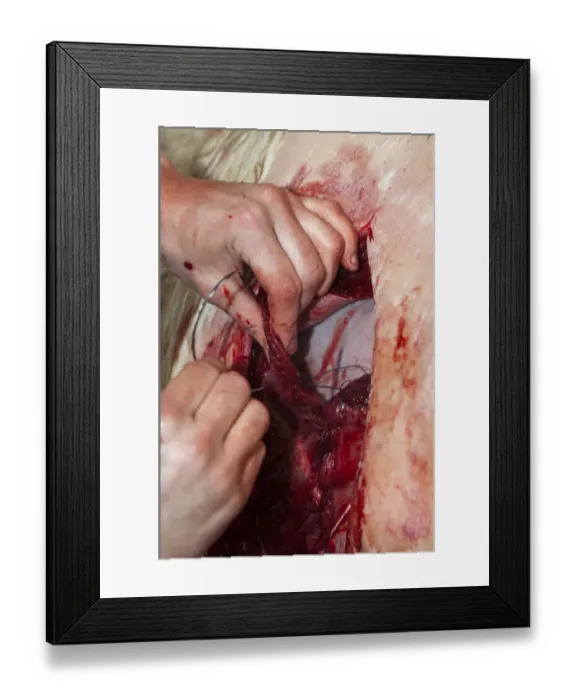 Framed Print : Cattle farming, close-up of vet stitching up cow after performing caesarean section to deliver calf, England, May Framed Print : Cattle farming, close-up of vet stitching up cow after performing caesarean section to deliver calf, England, May