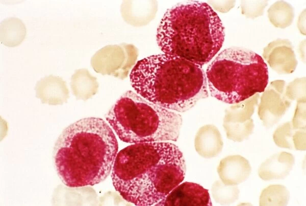 Acute promyelocytic leukaemia, micrograph