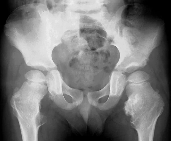 Bone growths, X-ray C018  /  0580