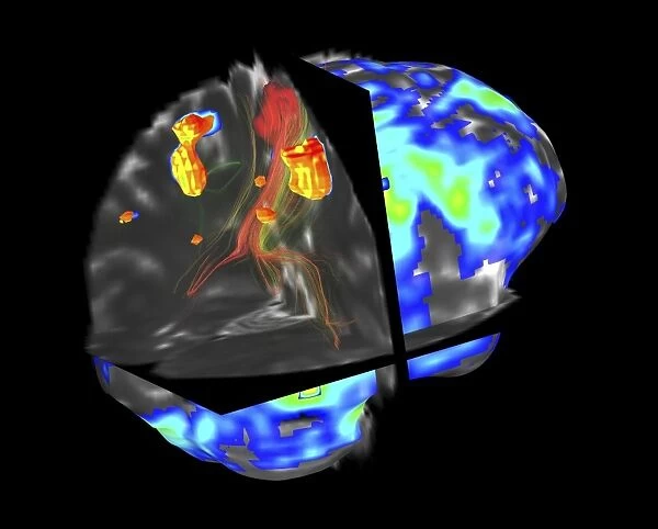 Brain tumour, fMRI and tractography C017  /  7102