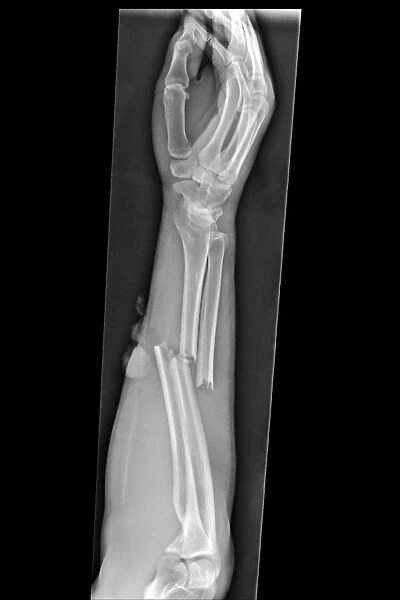Broken arm, X-ray C017  /  7863