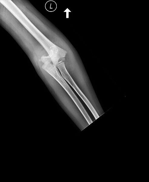 Broken elbow, X-ray C017  /  7266