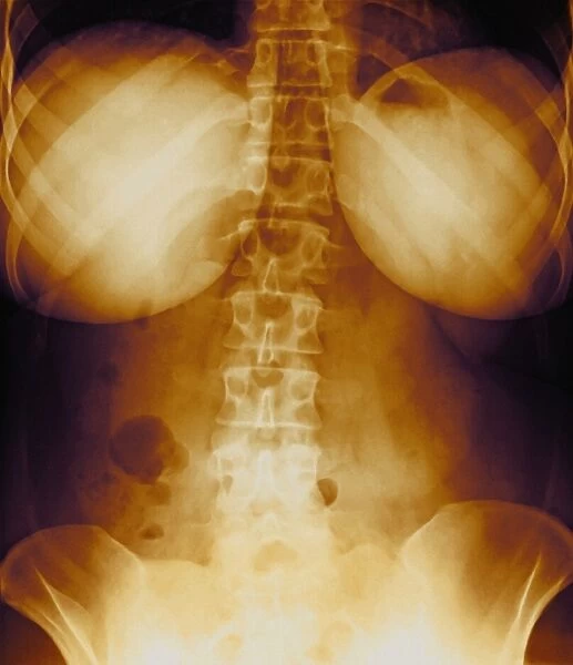 Female torso, X-ray