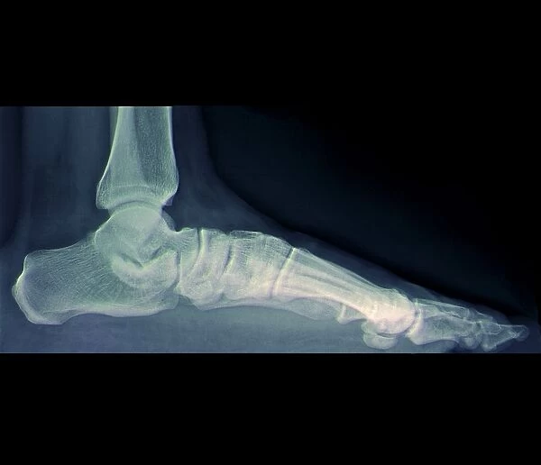 Flat foot, X-ray