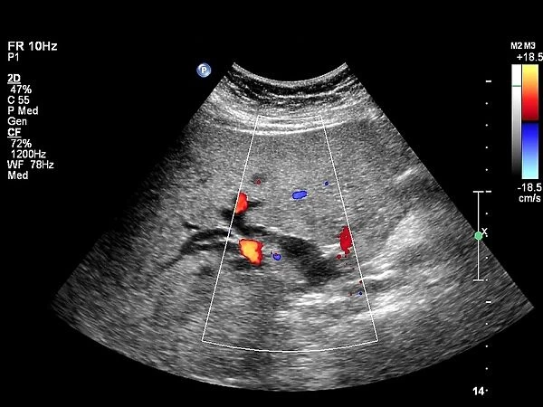 Gallstone, Doppler ultrasound scan C017  /  7859