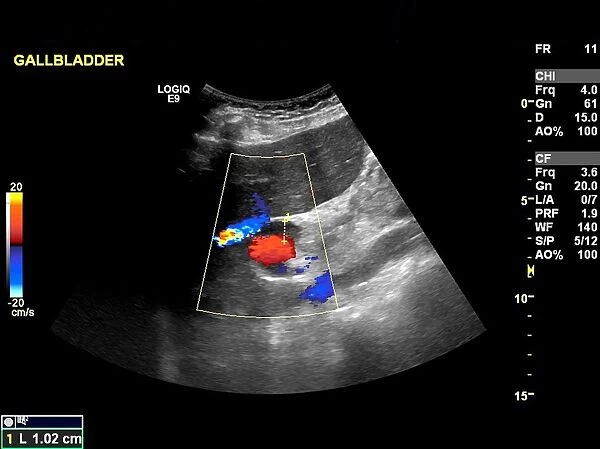 Gallstone, ultrasound scan C017  /  7643