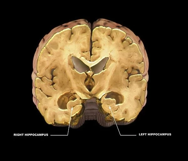 Healthy brain, MRI scan C018  /  0430