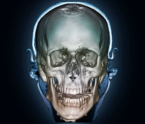 Human skull, 3D CT scan F006  /  9108