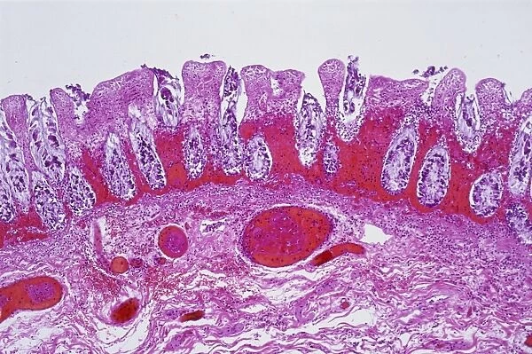 Ischaemic bowel, light micrograph