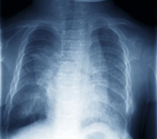 Jeune syndrome, X-ray C018  /  0410