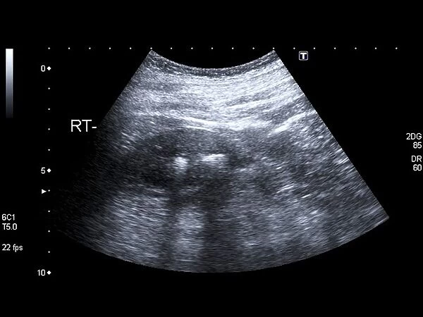 Kidney stones, ultrasound scan C017  /  7381