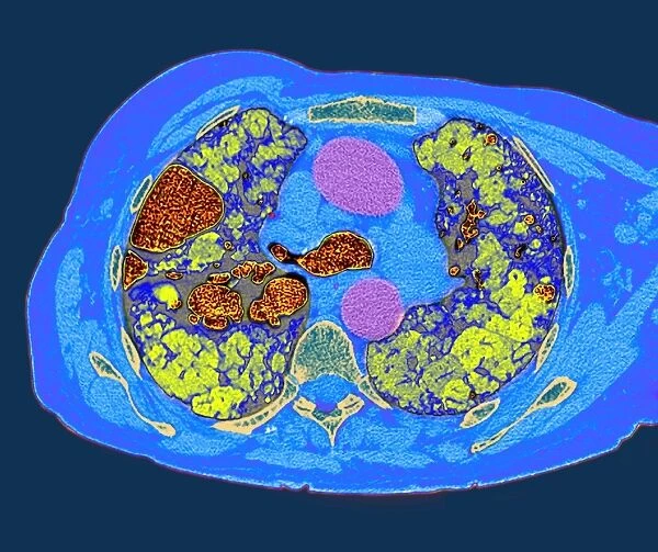 Lung fibrosis, CT scan