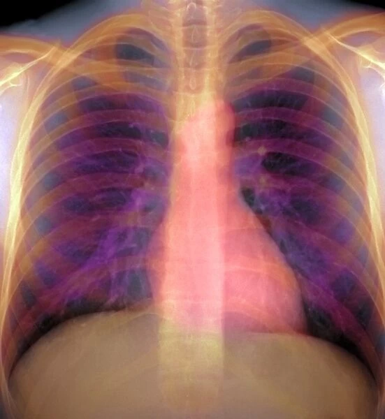 Lungs and heart, X-ray