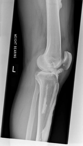 Melorheostosis of the knee, X-ray C017  /  7144