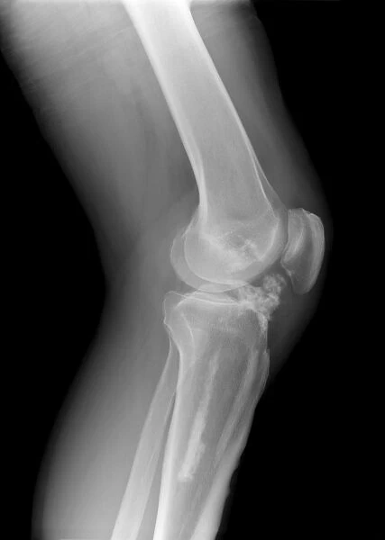 Melorheostosis of the knee, X-ray C017  /  7145