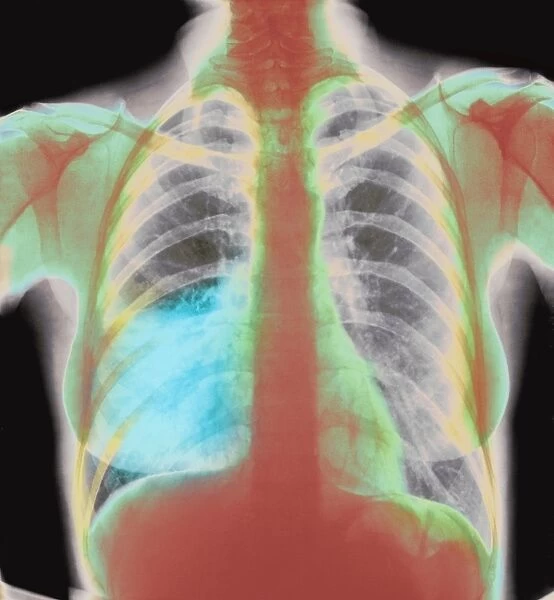 Pneumonia X-ray