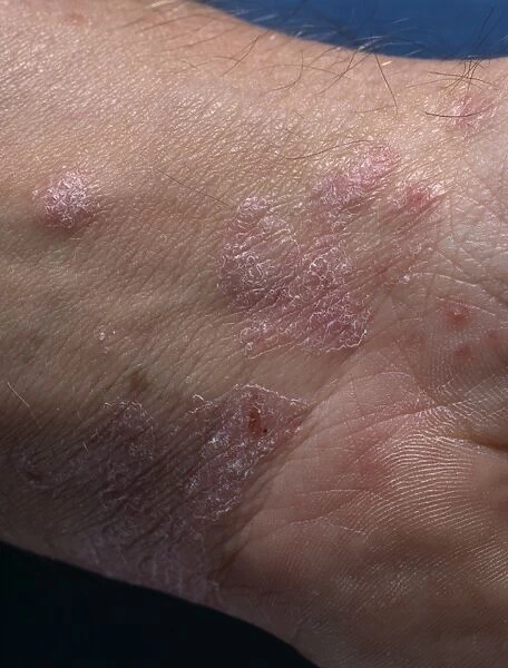 Psoriasis lesions on the skin of a mans wrist