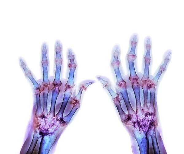 Rheumatoid arthritis, X-ray F008  /  3500