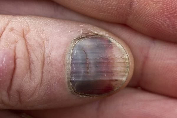After an accident to a fingernail it has turned black