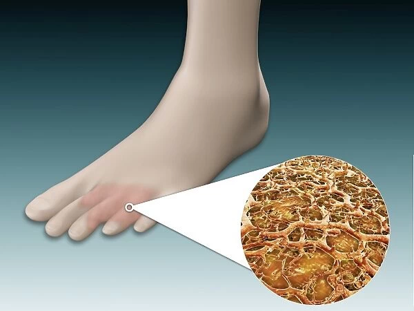 Anatomy of foot fungus with microscopic close-up