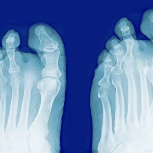 Amputated toe, X-rays