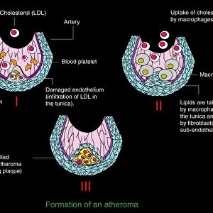 Atheroma formation, diagram