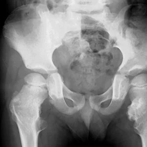 Bone growths, X-ray C018 / 0580