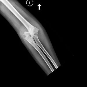 Broken elbow, X-ray C017 / 7266