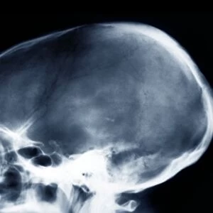 Dolichocephalic skull deformity, X-ray