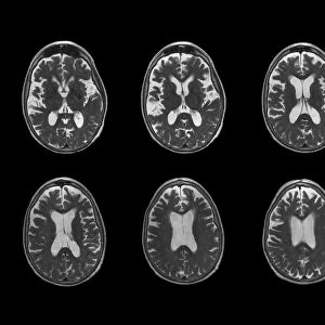 Early-onset Alzheimers disease, MRI scan