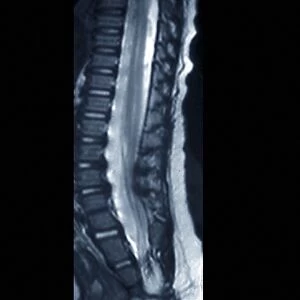 Fibrolipoma of the spine, MRI scan