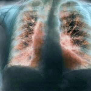 Fibrosing alveolitis, X-ray