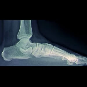 Flat foot, X-ray
