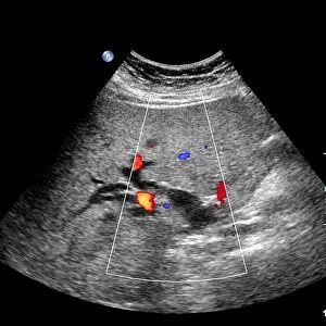 Gallstone, Doppler ultrasound scan C017 / 7859