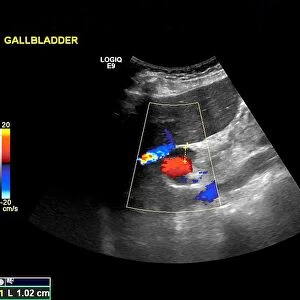 Gallstone, ultrasound scan C017 / 7643