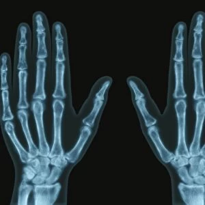 Hands, X-ray F006 / 8801