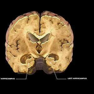 Healthy brain, MRI scan C018 / 0430