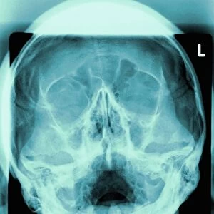 Healthy skull, X-ray