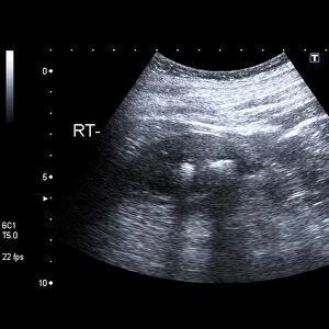 Kidney stones, ultrasound scan C017 / 7381