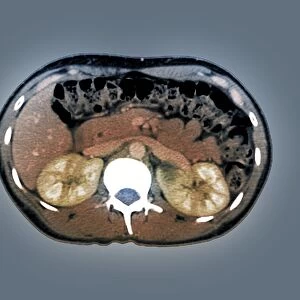 Medullary sponge kidney, CT scan