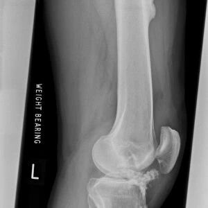Melorheostosis of the knee, X-ray C017 / 7144