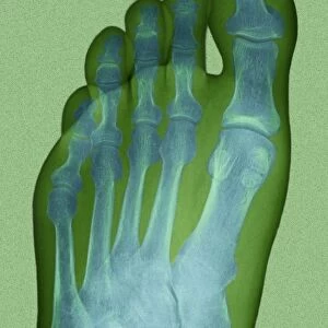 Normal foot, X-ray