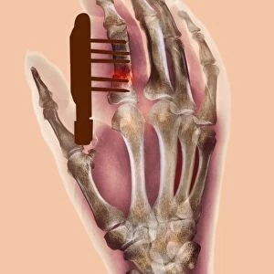 Pinned finger fracture, X-ray