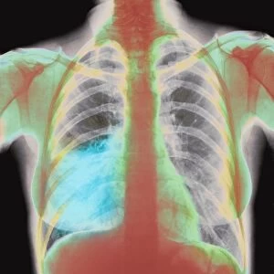 Pneumonia X-ray
