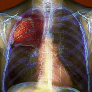 Pneumonia, X-ray