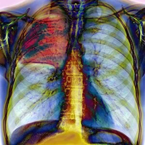 Pneumonia, X-ray