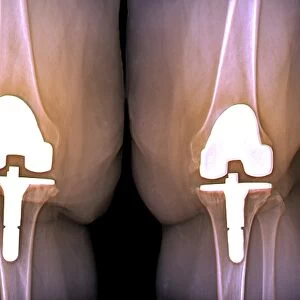 Prosthetic knees and obesity, X-ray C016 / 6598